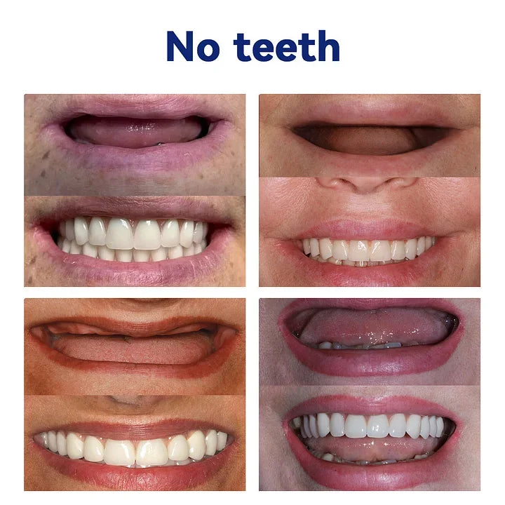EverSmile™ Teeth Veneers