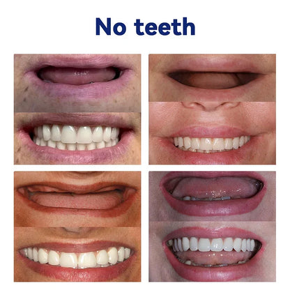 EverSmile™ Teeth Veneers